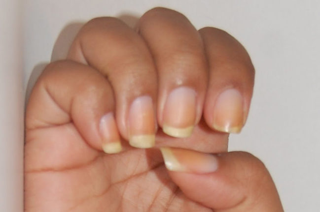 Are You Nutritionally Deficient? Look at Your Nails! -